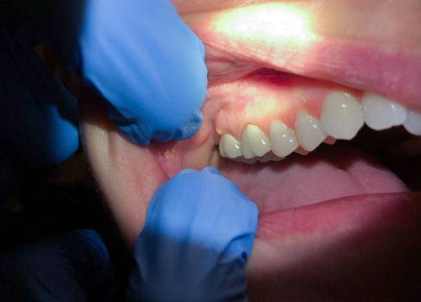 Best Emergency Tooth Extraction in Washington, NJ